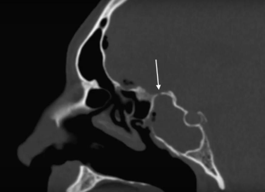 Лікворея 2 фото Лікворея 1 Тернопіль