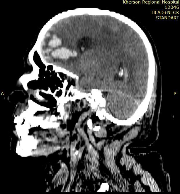 Забій головного мозку тяжкого ступеня 3 Тернопіль