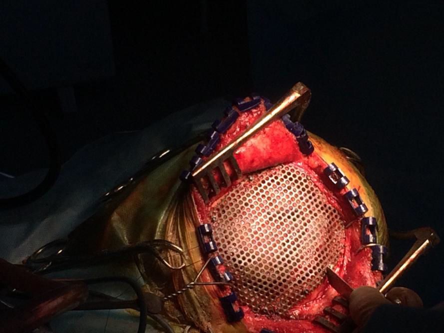 Пухлини кісток черепа 4 фото Пухлини кісток черепа 3 Тернопіль