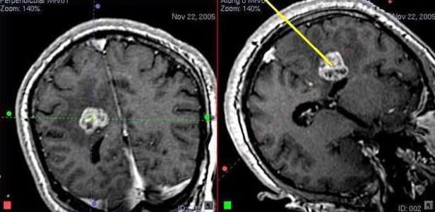 Біопсія (діагностика) внутрішньомозкових пухлини 2 фото Біопсія (діагностика) внутрішньомозкових пухлини 1 Тернопіль