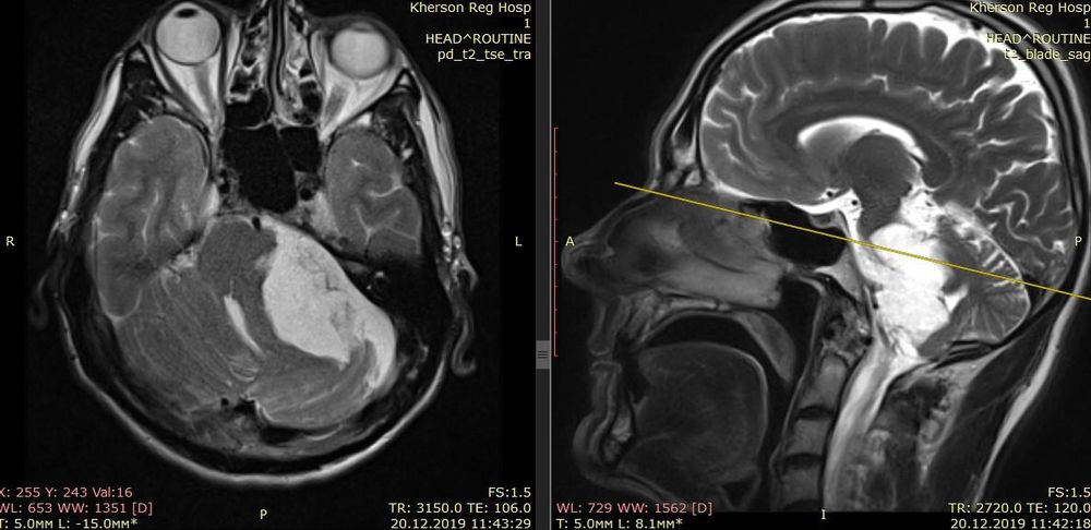 Внутрішньомозкові пухлини 7 Тернопіль