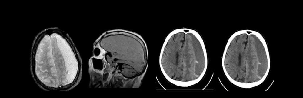 Видалення хронічних субдуральних гематом 2 фото Видалення хронічних субдуральних гематом 1 Тернопіль