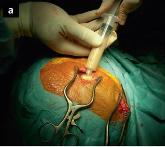 Діагностичні операції (пункції, біопсії) 3 Тернопіль