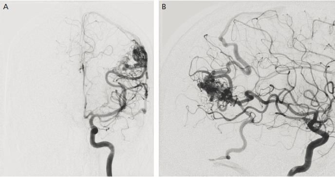 Surgical removal of arteriovenous malformations 3 Тернопіль