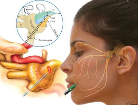 Радіочастотна деструкція окремих гілок трійчастого нерва 4 фото Радіочастотна деструкція окремих гілок трійчастого нерва 3 Тернопіль