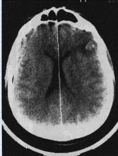 Забій головного мозку середнього ступеня 1 Тернопіль