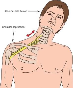 Brachial plexus plexitis 4 фото Brachial plexus plexitis 3 Тернопіль