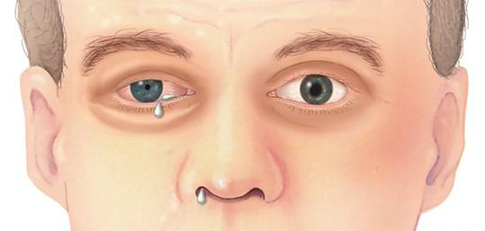 Paroxysmal hemicrania 1 Тернопіль