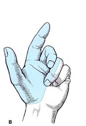 Больові синдроми в нейрохірургії 3 фото рука акушера