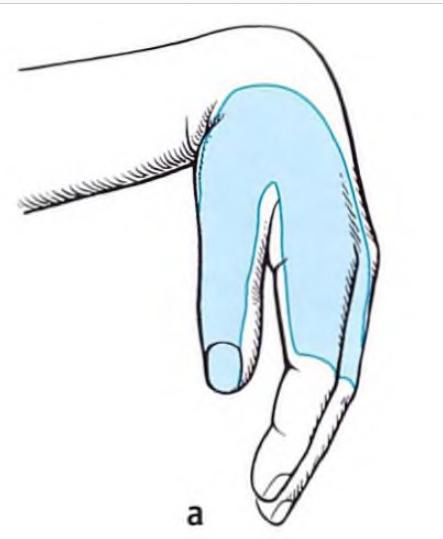 Больові синдроми в нейрохірургії 1 фото звисаюча кисть