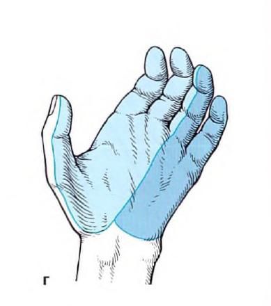 Больові синдроми в нейрохірургії 4 фото мавпяча кисть