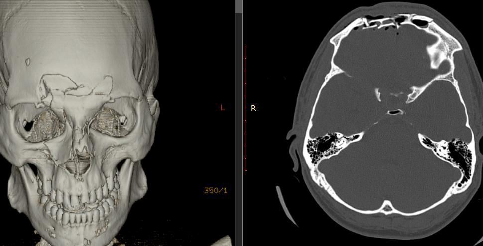 Внутрішньочерепні гематоми і вдавлені переломи склепіння черепа 17 Тернопіль