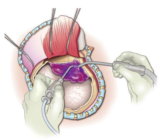 Внутрішньочерепні гематоми і вдавлені переломи склепіння черепа 5 Тернопіль