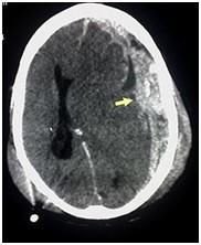 Внутрішньочерепні гематоми і вдавлені переломи склепіння черепа 7 Тернопіль