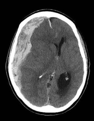 Внутрішньочерепні гематоми і вдавлені переломи склепіння черепа 9 Тернопіль