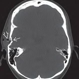 Внутрішньочерепні гематоми і вдавлені переломи склепіння черепа 11 Тернопіль