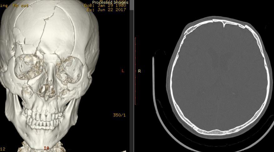 Внутрішньочерепні гематоми і вдавлені переломи склепіння черепа 13 Тернопіль