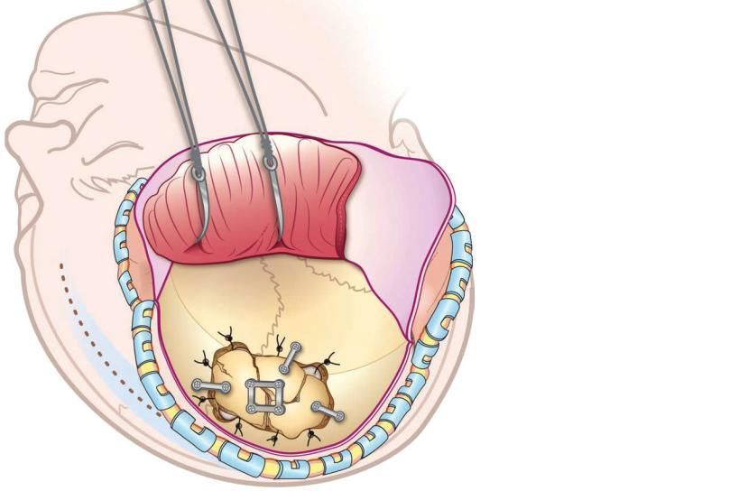 Внутрішньочерепні гематоми і вдавлені переломи склепіння черепа 15 Тернопіль