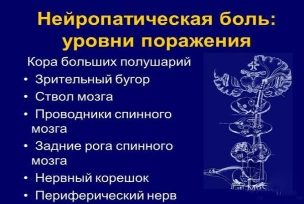 Нейропатическая боль