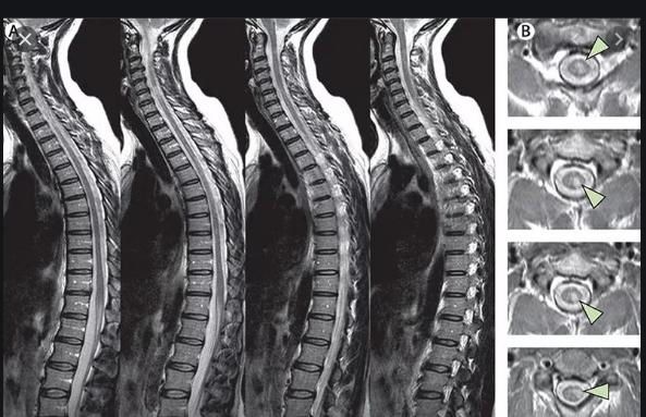 Струс і забій спинного мозку 2 Тернопіль