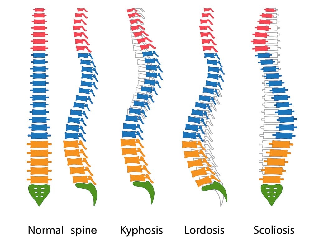 Deformation of the spine 2 фото Deformation of the spine 1 Тернопіль