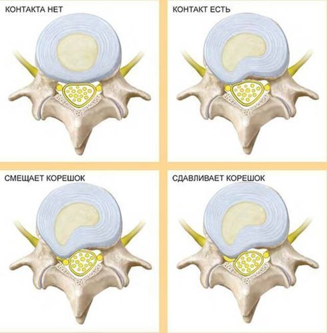 Грижі міжхребцевих дисків на будь-якому рівні 4 фото Грижі міжхребцевих дисків на будь-якому рівні 3 Тернопіль