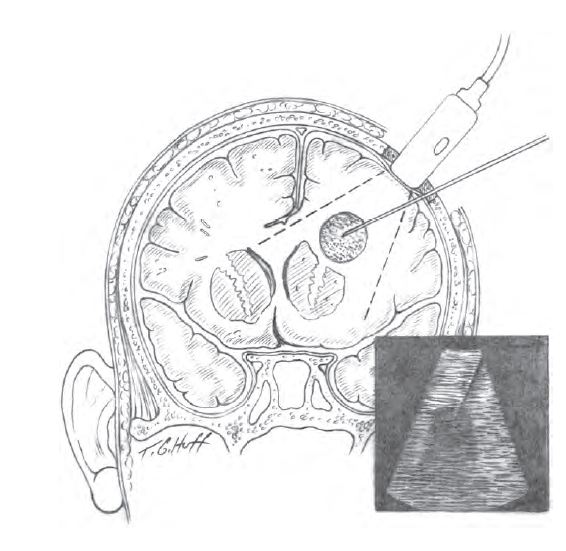 Інфекційні ураження головного і спинного мозку 10 фото Інфекційні ураження головного і спинного мозку 9 Тернопіль