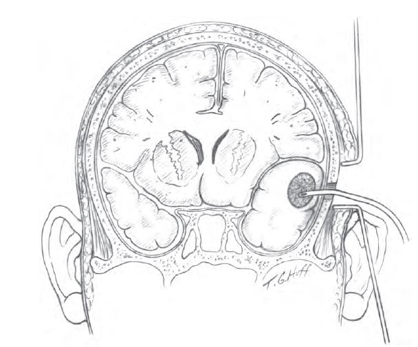 Радикальні операції: розтин і дренування абсцесів, емпієм 6 фото Радикальні операції: розтин і дренування абсцесів, емпієм 5 Тернопіль