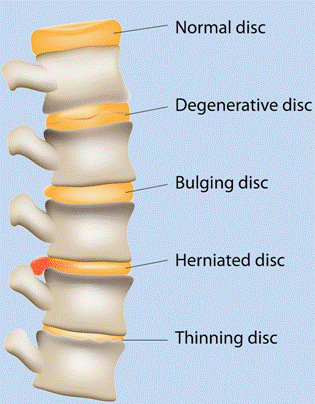 Дегенеративно-дистрофічні захворювання хребта (ДДЗХ) 2 фото Дегенеративно-дистрофічні захворювання хребта (ДДЗХ) 1 Тернопіль