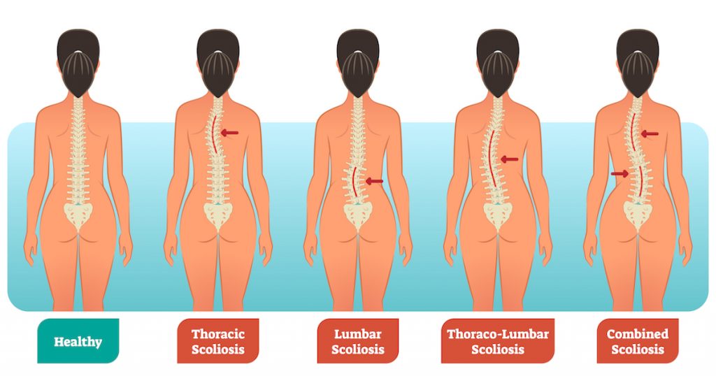 Сколіоз 1 Тернопіль