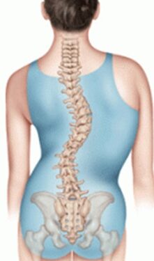 Сколіоз 3 Тернопіль