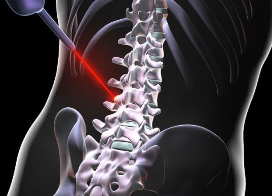 Лазерна абляція пухлини хребта 2 фото Лазерна абляція пухлини хребта 1 Тернопіль