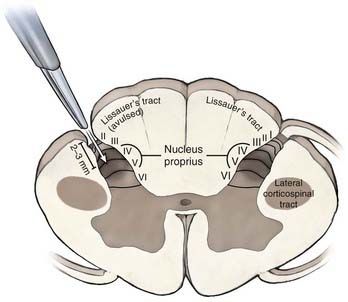 DREZ-операція 2 фото DREZ-операція 1 Тернопіль