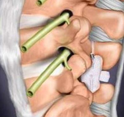 Видалення грижі диска і встановлення протеза DIAM 2 фото Видалення грижі диска і встановлення протеза DIAM 1 Тернопіль