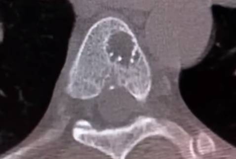 Пухлини хребта різної локалізації 2 фото Пухлини хребта різної локалізації 1 Тернопіль