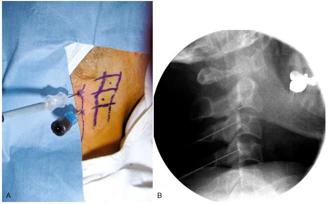 Міофасциальний синдром 4 фото Міофасциальний синдром 3 Тернопіль