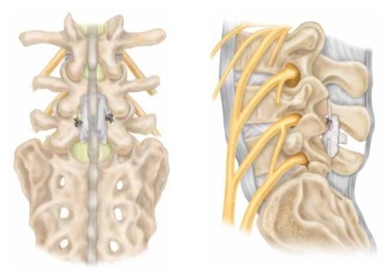 Видалення грижі диска і встановлення протеза DIAM 4 фото Видалення грижі диска і встановлення протеза DIAM 3 Тернопіль