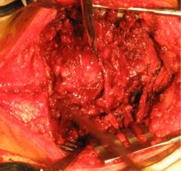 Пухлини хребта різної локалізації 8 фото Пухлини хребта різної локалізації 7 Тернопіль