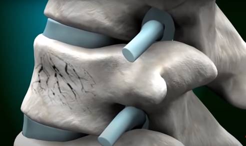 Пухлини хребта різної локалізації 4 фото Пухлини хребта різної локалізації 3 Тернопіль