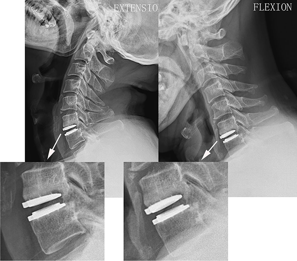 Протезування дисків в шийному відділі рухливими протезами 6 фото Протезування дисків в шийному відділі рухливими протезами 5 Тернопіль