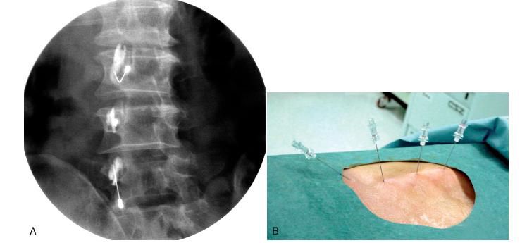 Міофасциальний синдром 6 фото Міофасциальний синдром 5 Тернопіль