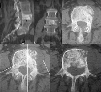 Пухлини хребта різної локалізації 10 фото Пухлини хребта різної локалізації 9 Тернопіль
