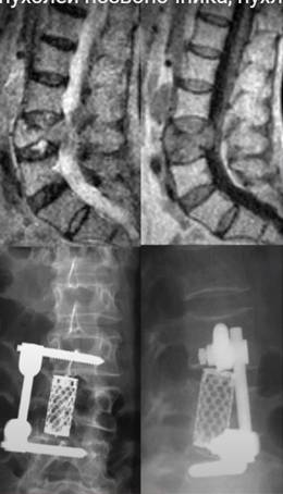 Пухлини хребта різної локалізації 12 фото Пухлини хребта різної локалізації 11 Тернопіль