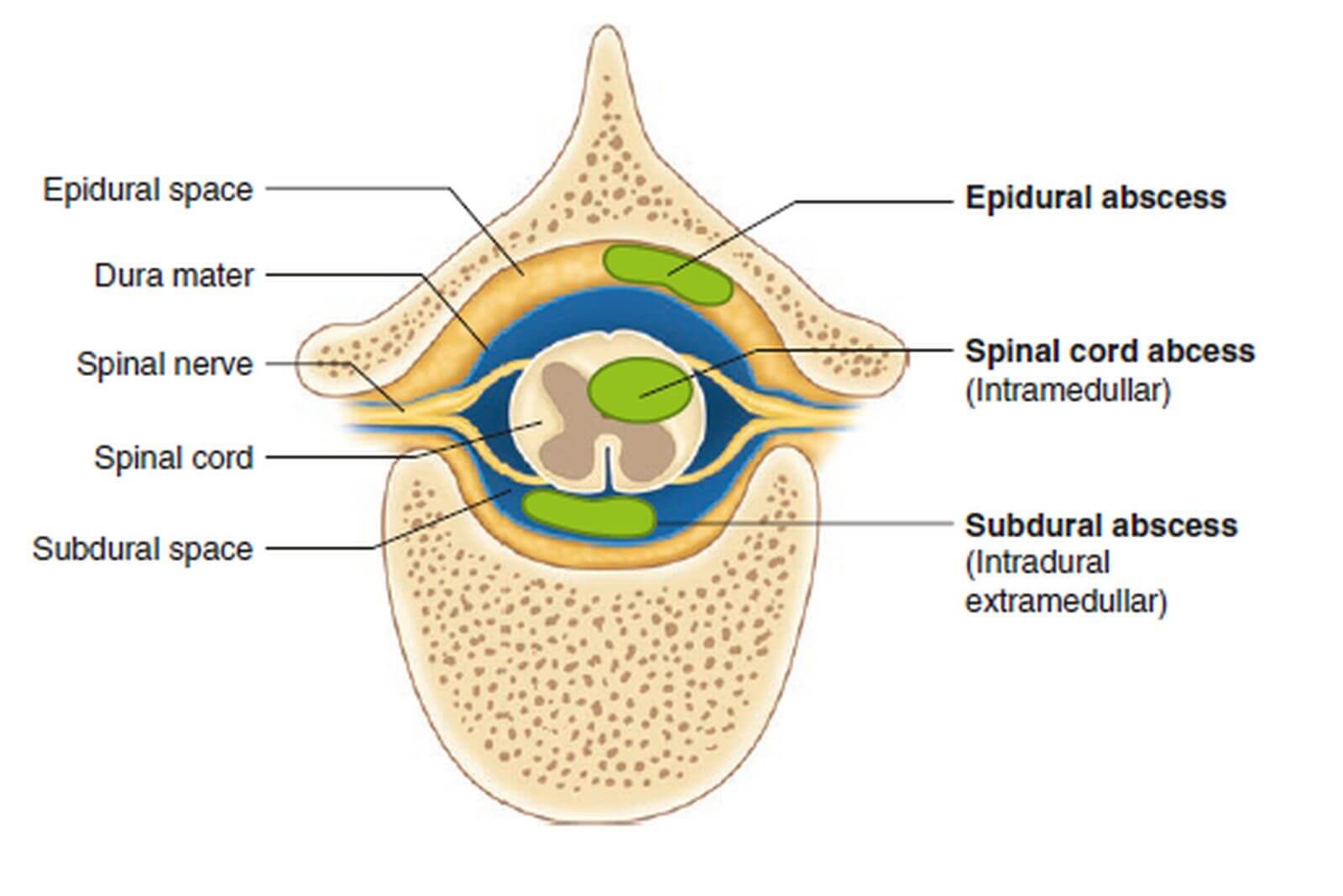 Радикальні операції: розтин і дренування абсцесів, емпієм 4 фото Радикальні операції: розтин і дренування абсцесів, емпієм 3 Тернопіль