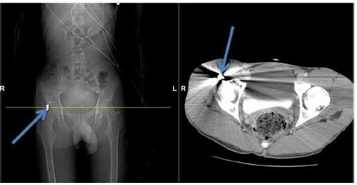 Протезування дисків в шийному відділі рухливими протезами 10 фото Протезування дисків в шийному відділі рухливими протезами 9 Тернопіль