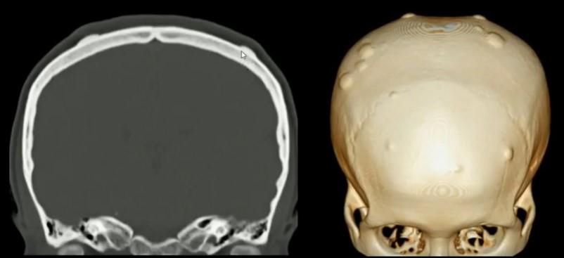Біопсія (діагностика) внутрішньомозкових пухлини 5 фото Біопсія (діагностика) внутрішньомозкових пухлини 4 Тернопіль
