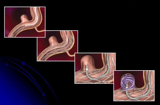Захворювання судин головного мозку та шиї 4 фото Ендоваскулярна емболізація херсон
