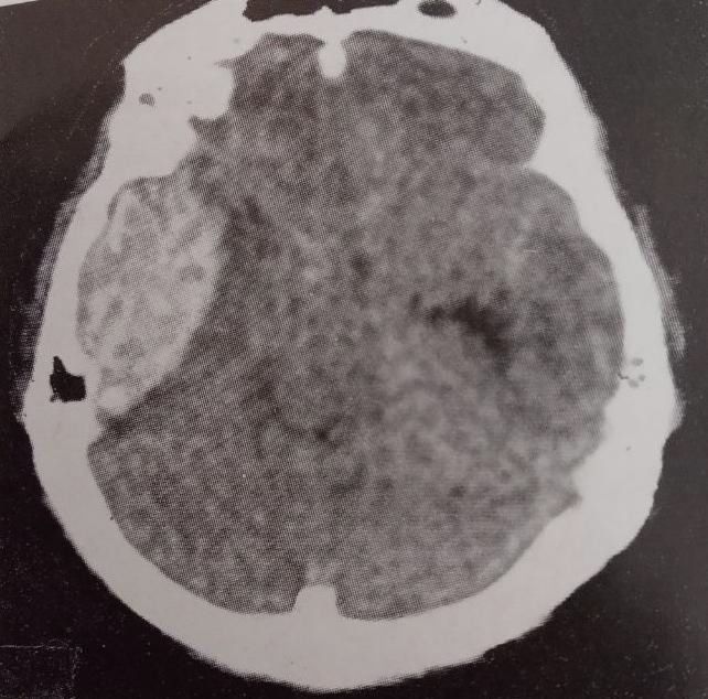 Субдуральна гематома 3 Тернопіль