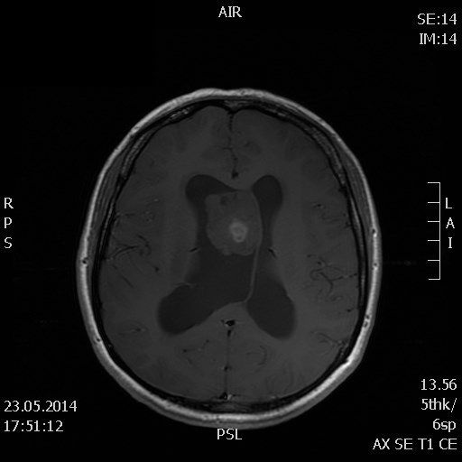Пухлини кісток черепа 7 фото Пухлини кісток черепа 6 Тернопіль