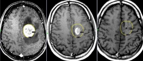 Пухлини кісток черепа 9 фото Пухлини кісток черепа 8 Тернопіль